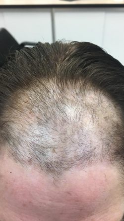 hair loss