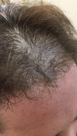 Hair Replacement Solutions in Pahrump, NV