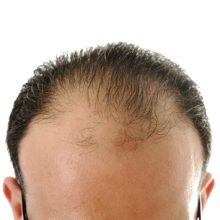 Hair Replacement Solutions in Clark County, NV