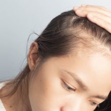 Young,Women,Stressed,And,Having,Hair,Loss,,Thinning,Hair