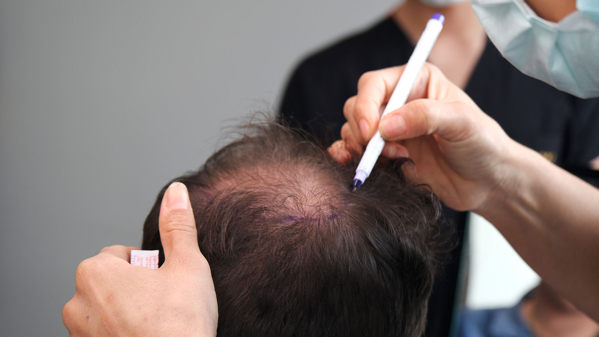 Hair Replacement Services in Laughlin, NV