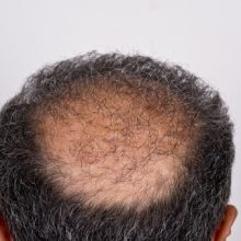 Six,Months,After,Hair,Transplant,Surgery