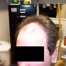 hair loss male client