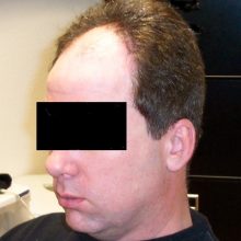 hair loss male client