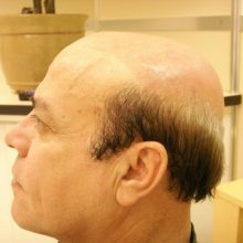 hair loss client