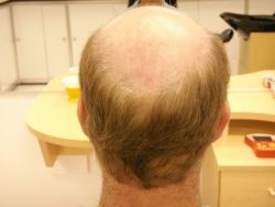 Hair Replacement Solutions in Pahrump, NV