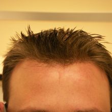 hair treatment results